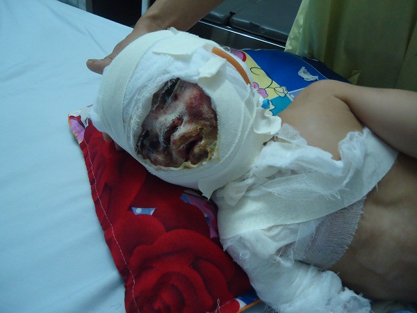 Bé trai vùng cao 1 tuổi bỏng nặng xin được cứu giúp