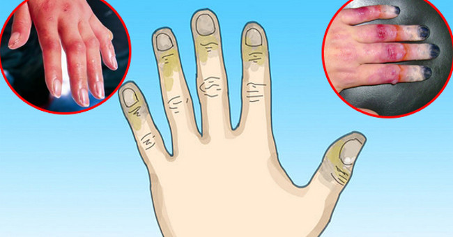 Hướng Dẫn Sơ Cứu và Điều Trị Bỏng Lạnh Hiệu Quả