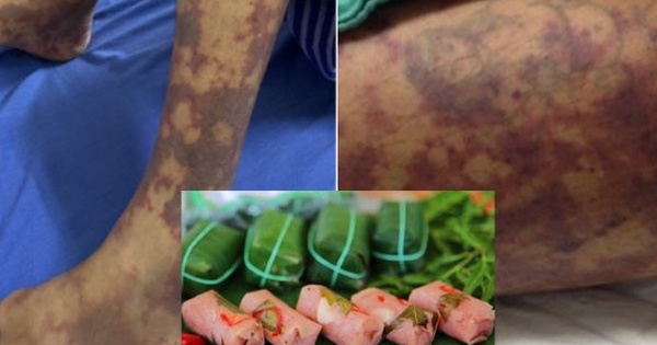 Thích ăn nem chua, thịt lợn tái, người đàn ông mắc căn bệnh nguy hiểm sau triệu chứng đau đầu